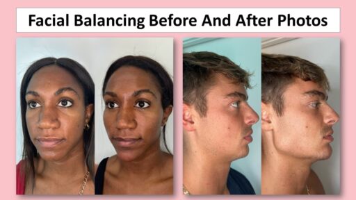 Facial Balancing Before And After