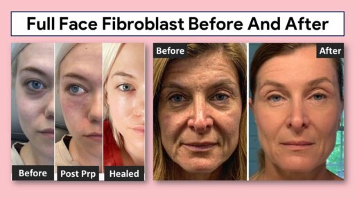 Full Face Fibroblast Before And After