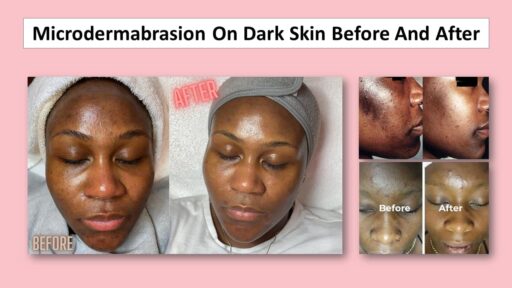 Microdermabrasion On Dark Skin Before And After