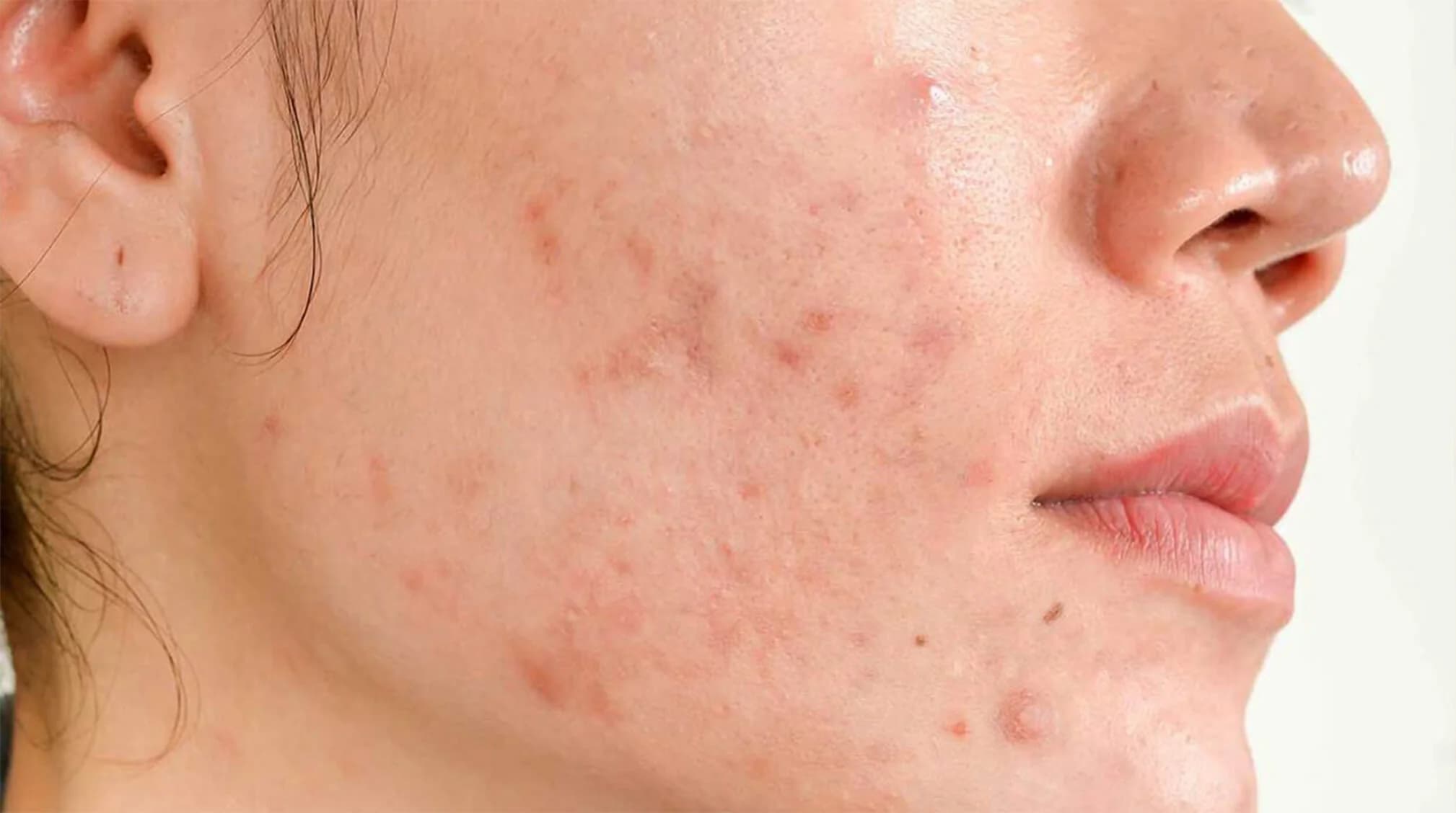 horomonal acne